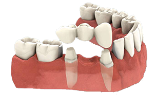 Dental-Bridge_1