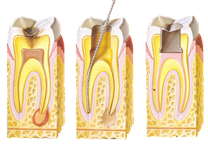 Root-Canal